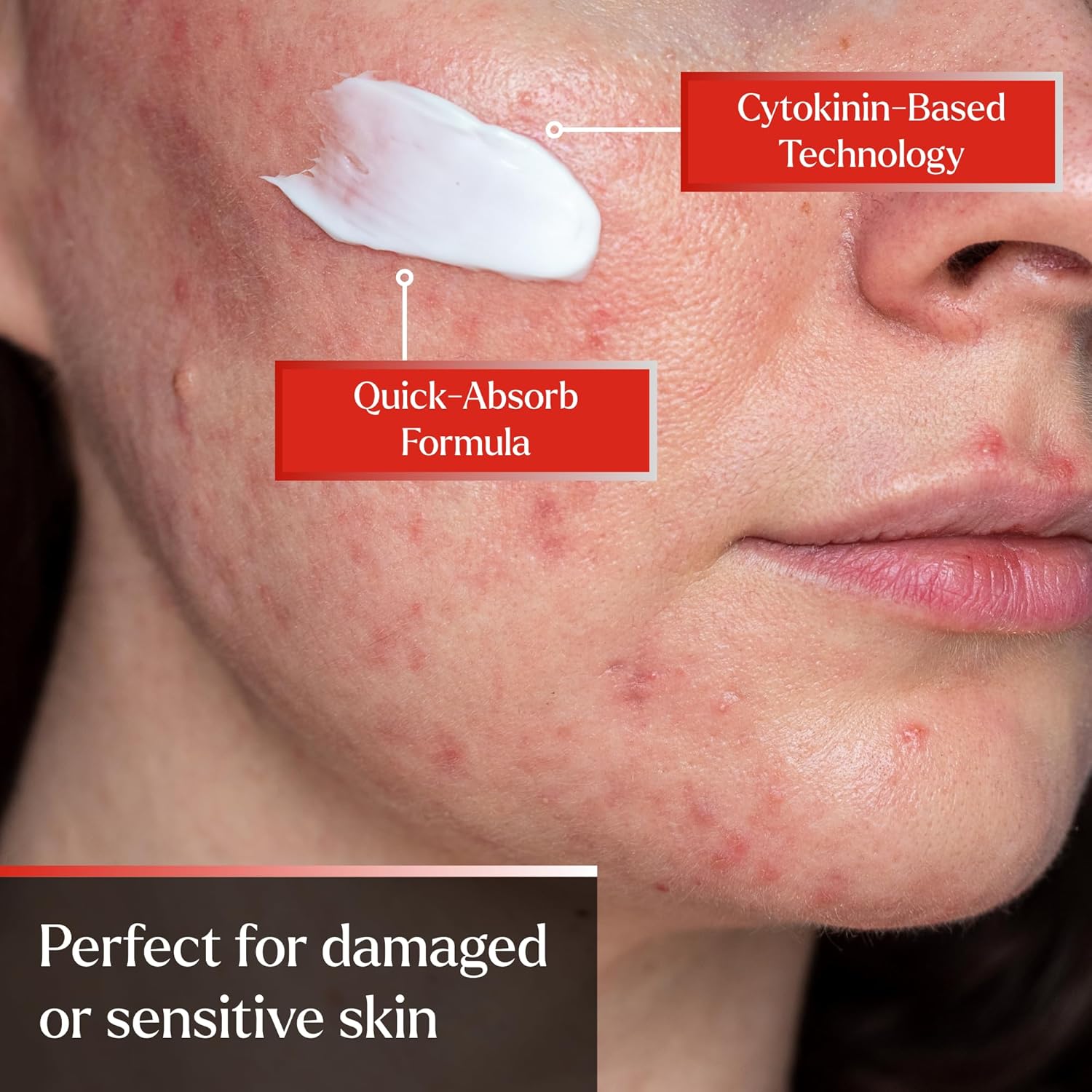 PyratineXR Crème - Antiaging & Rosacea Treatment - Ultimate Cytokinin Skin Cream Reduces Facial Redness, Acne Lesions, Spider Veins, Fine Lines, Wrinkles, & Mottled Hyperpigmentation - 2 oz.