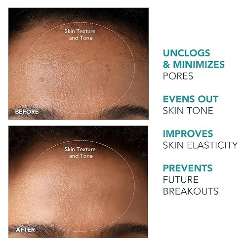 Miniatura 5 de FOREO Extractor de puntos negros KIWI