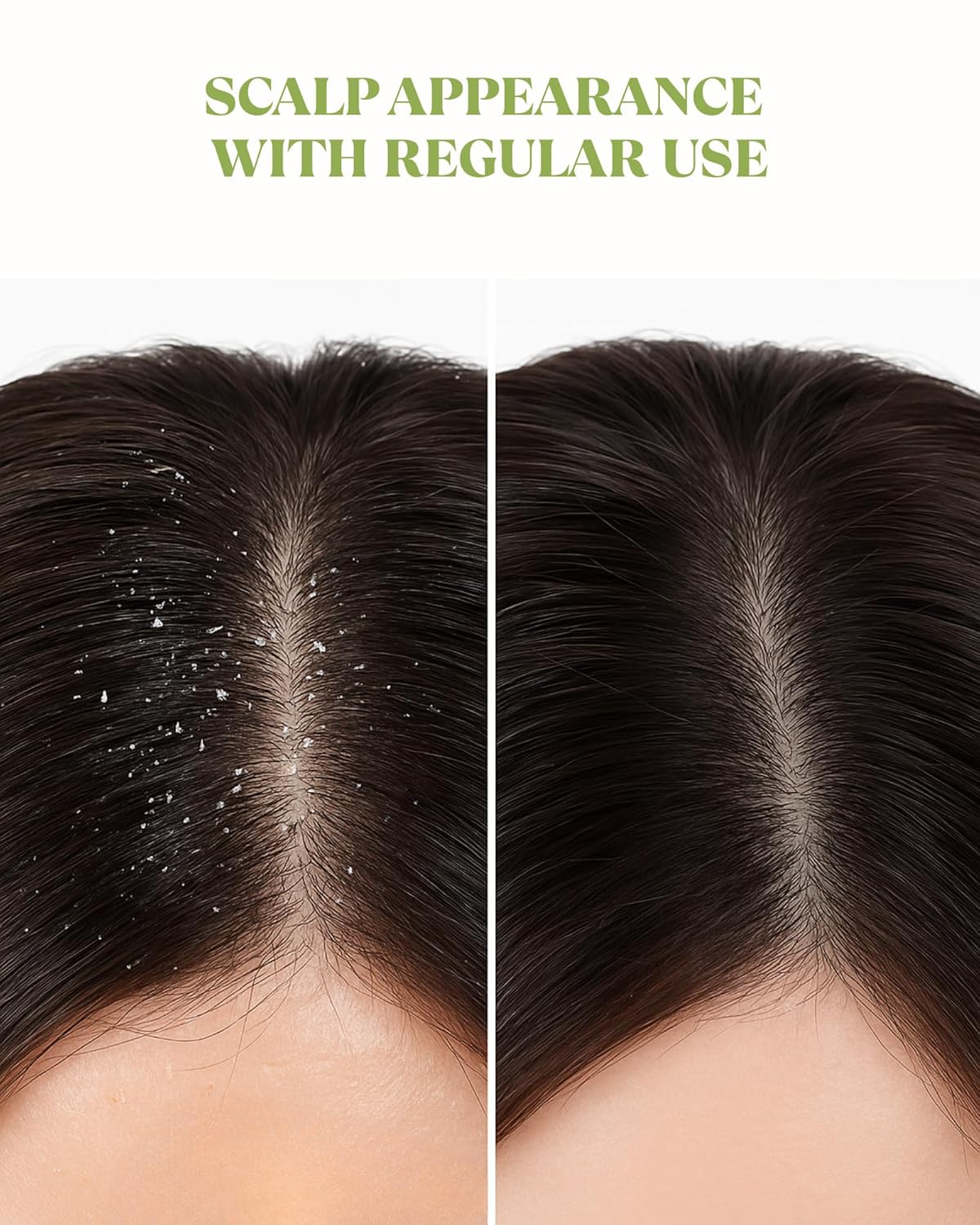 Psoriasis Shampoo for Men & Women 1% Zinc Pyrithione for Itchy, Flaky Scalp | Hydrating Daily Scalp Care with Aloe,Hyaluronic Acid & Botanical Extracts | Hydrating Dandruff Formula - Image 4