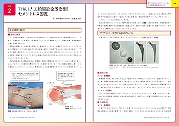 オペナーシング オペナーシング 2024年12月号〈特集〉人工関節置換術バイブル