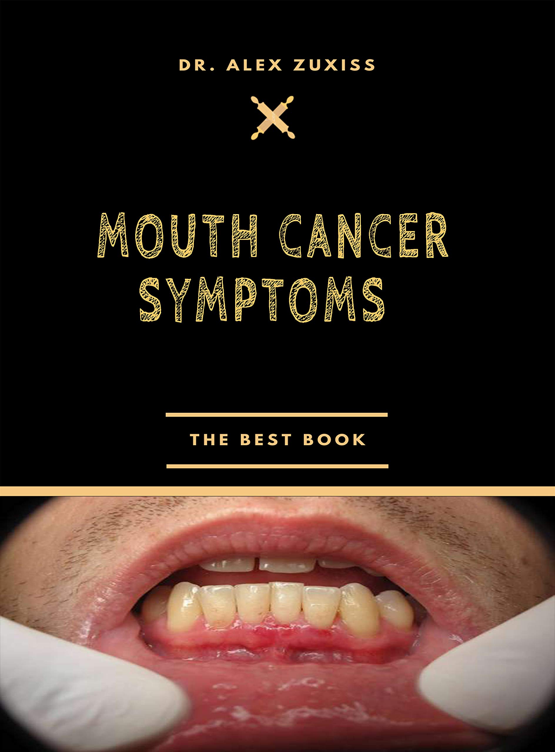 Buy Mouth Cancer Symptoms Ulcer That Does Not Heal White Patches