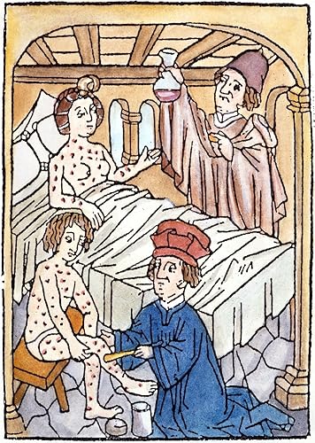 Miniatura 1 de Sífilis medieval 1497 Na Doctor inspecciona la muestra de orina de una paciente con sífilis mientras su colega aplica un ungüento a un paciente