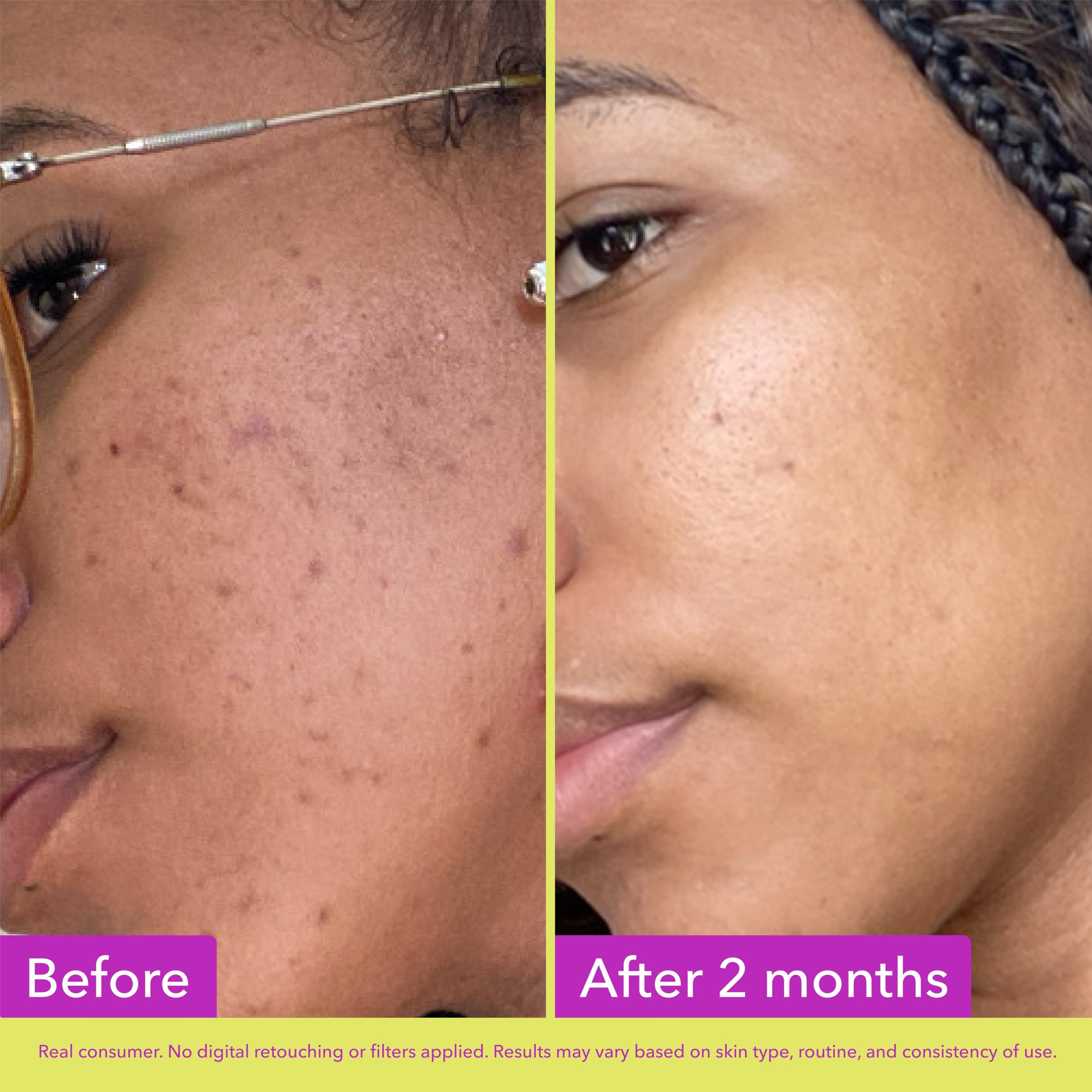 Good Molecules Azelaic Acid Serum - Brighten & Calm Skin -5