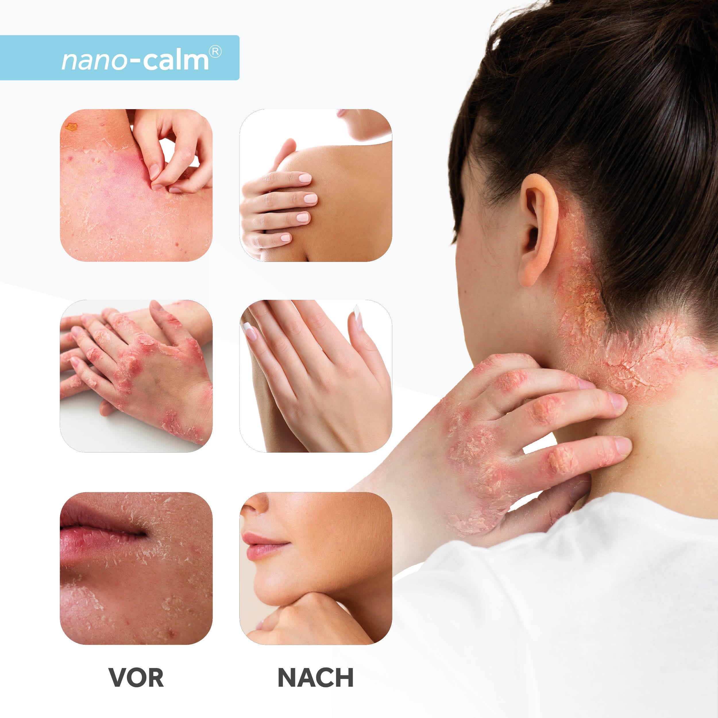 Medskina Neurodermitis Spray 75 ml - Hilfe bei Psoriasis Schuppenflechte und trockener Haut - Spray gegen Hautpilz und Juckreiz - Wundspray schnelle Wundheilung - MADE IN SWISS