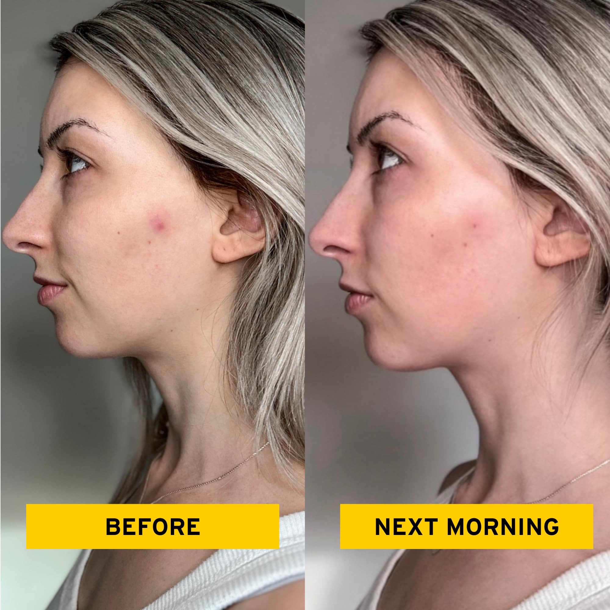 No Bad Stuff Acne Patch Duo – Day & Night Hydrocolloid Pimple Patches