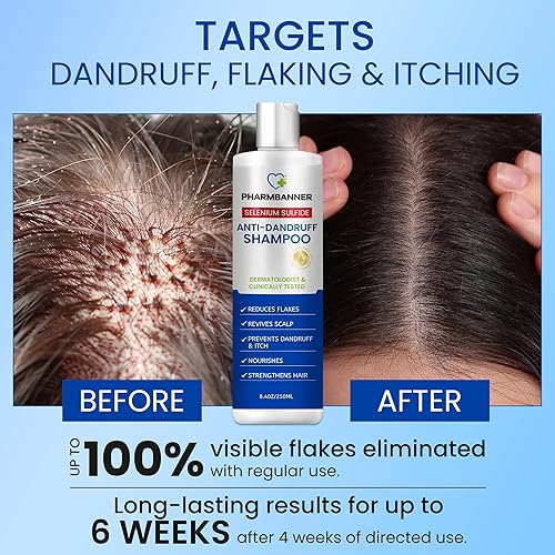 Miniatura 2 de Champú anticaspa con sulfuro de selenio  Fórmula antifúngica medicada para dermatitis seborreica y foliculitis  Alivio del cuero cabelludo graso y