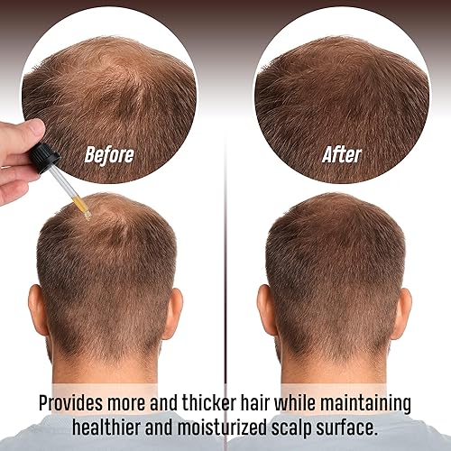 Miniatura 3 de GF - Suero para el crecimiento del cabello para hombres y mujeres, bloqueador de DHT, tratamiento contra la pérdida de cabello, estimula el