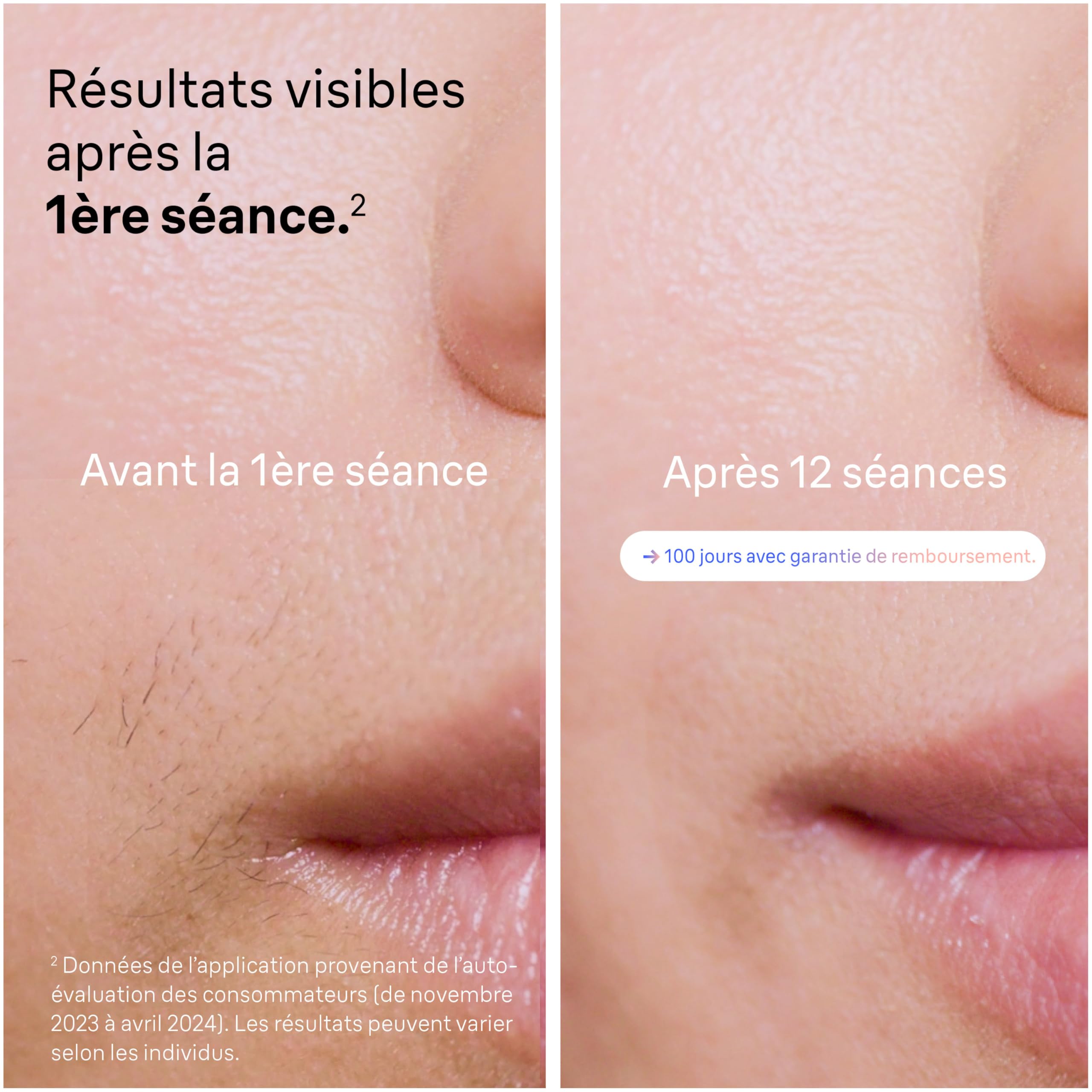 Braun Epilateur A Lumiere Pulsee Intelligent Skin i·expert PL7387, Epilation A Domicile, Alternative Au Laser, Avec Appli, Rasoir Gillette Venus, 4 Têtes Intelligentes Pour Epiler Jambes, Visage, Plus | Épilation laser alternative pour la maison, épilatio