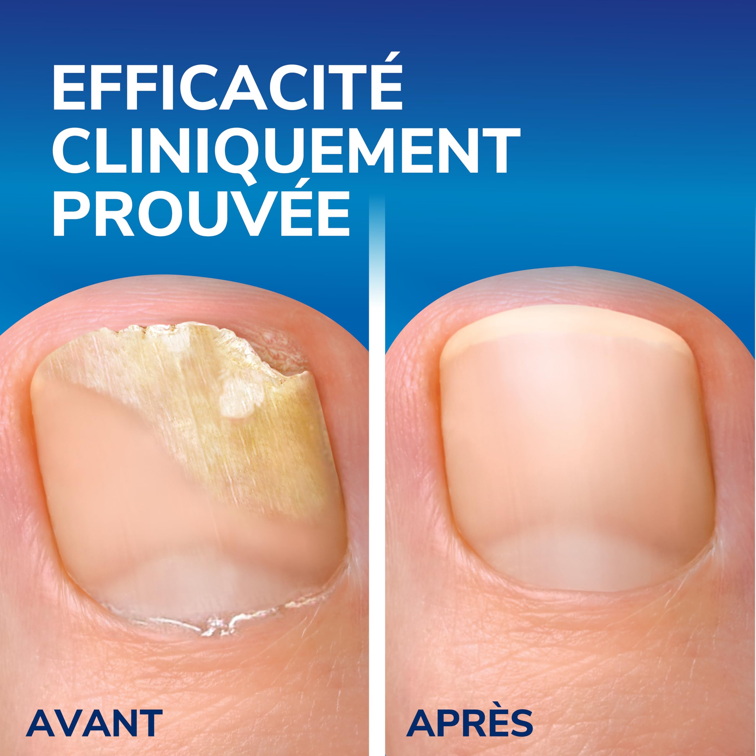 Dr. Scholl's Mycose des ongles 2-en-1 Traitement et Protection - Amélioration immédiate et visible - Facile à utiliser - Efficacité cliniquement prouvée - 3,8 mL