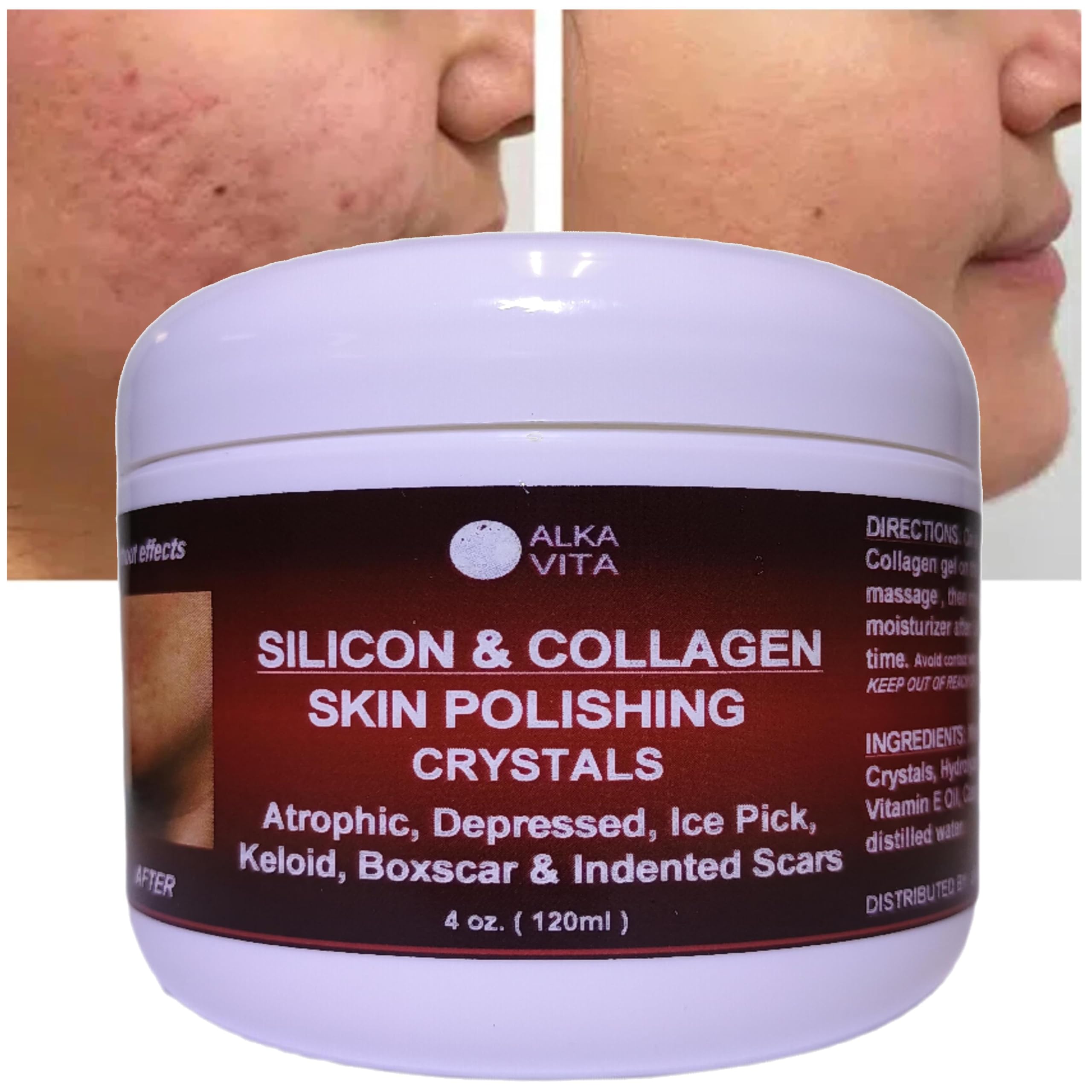 Amazon.com : Acne Scars Silicon & Collagen Skin Polishing Crystals