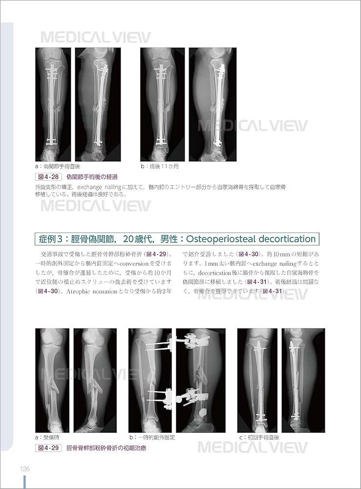 Amazon.co.jp: 白熱講義 骨折合併症 Nonunion, Malunion, FRI