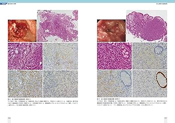 下部消化管癌 | 青笹克之, 小田義直, 都築豊徳, 新井冨生 |本