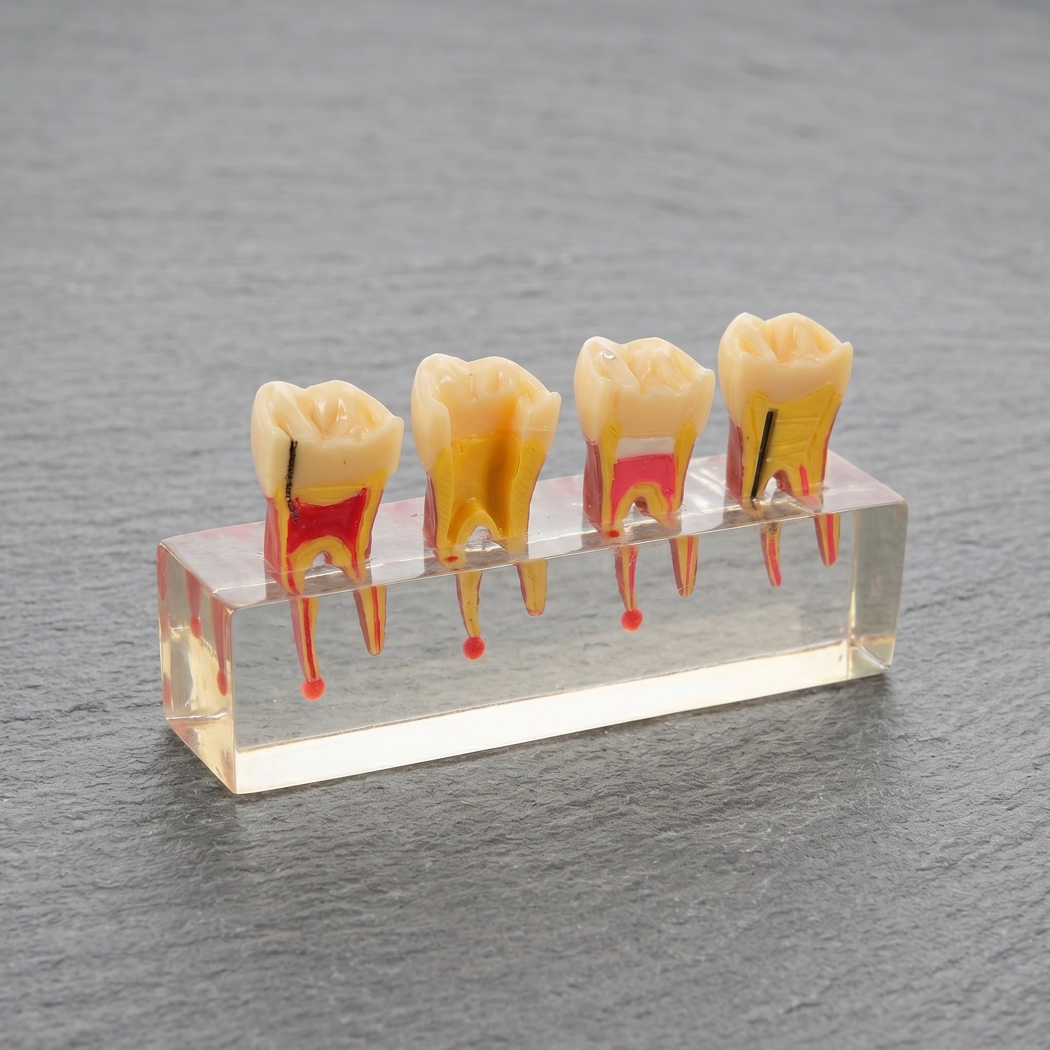 ibasenice Modello di denti pediatrici per la formazione didattica | Rappresentazione realistica dell'anatomia della bocca per studenti di odontoiatria e dentisti | Modello di carie per