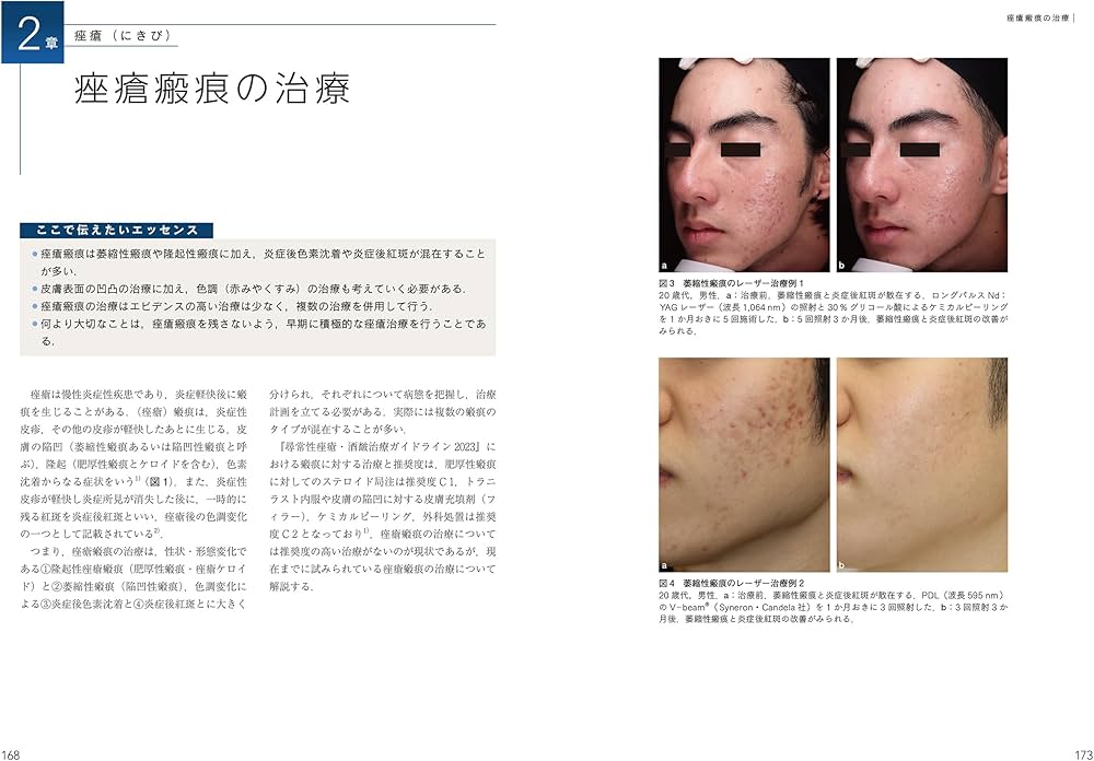 脱毛・にきびの治療 美容皮膚科オールラウンド　最新美容皮膚科学大系　5 医学書 脱毛・にきびの治療ー美容皮膚科オールラウンド (最新美容皮膚