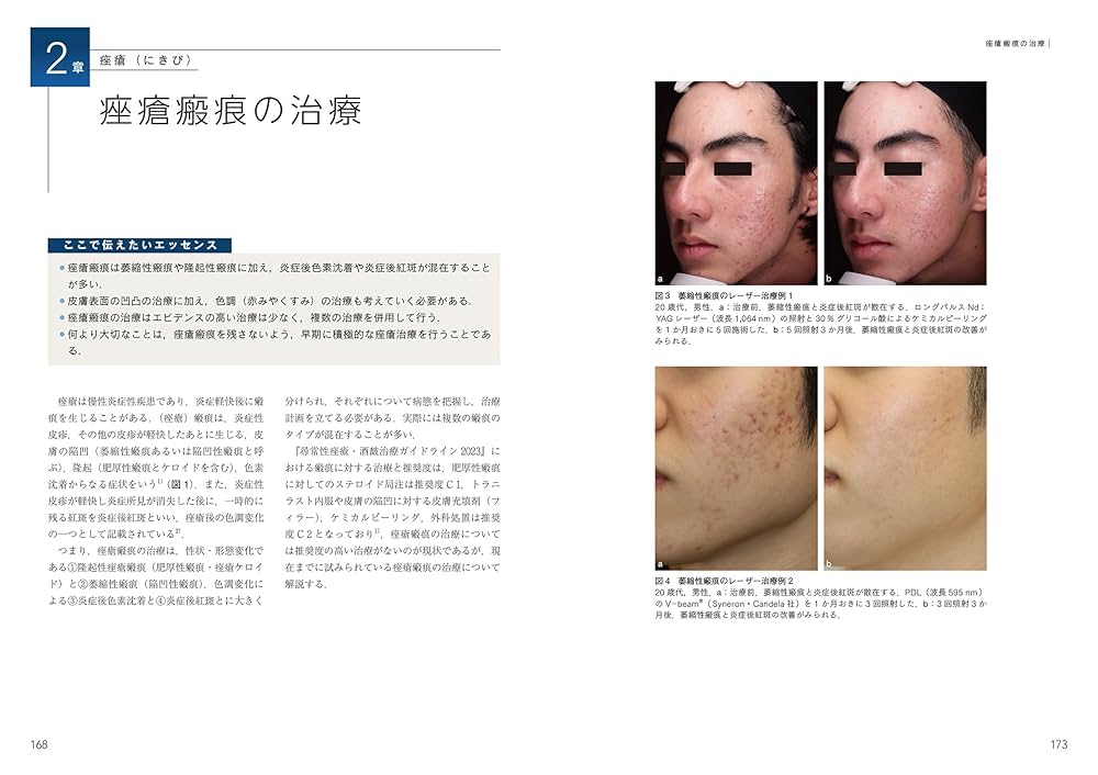 脱毛・にきびの治療 美容皮膚科オールラウンド　最新美容皮膚科学大系　5 医学書 脱毛・にきびの治療ー美容皮膚科オールラウンド (最新美容皮膚