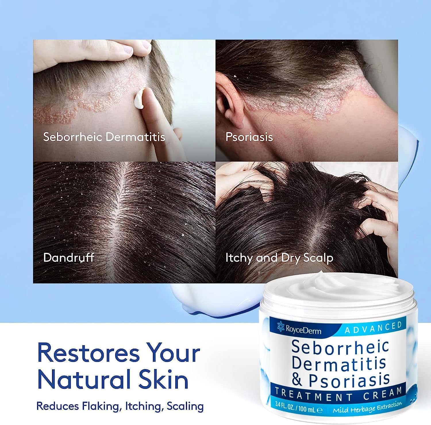 Roycederm 2-Step Seborrheic Dermatitis & Psoriasis Care Bundle - Calming Serum + Treatment Cream