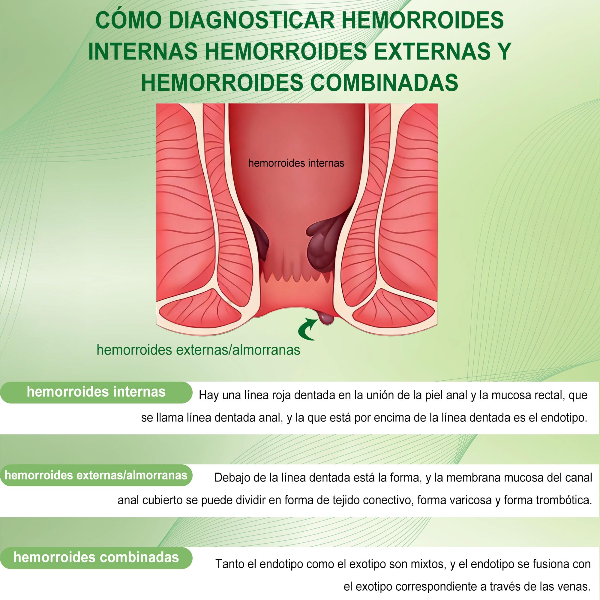 Crema para aliviar las hemorroides, adecuada para aliviar el dolor, la hinchazón, la picazón y el sangrado, protegiendo la piel delicada (20G 1-Pack)