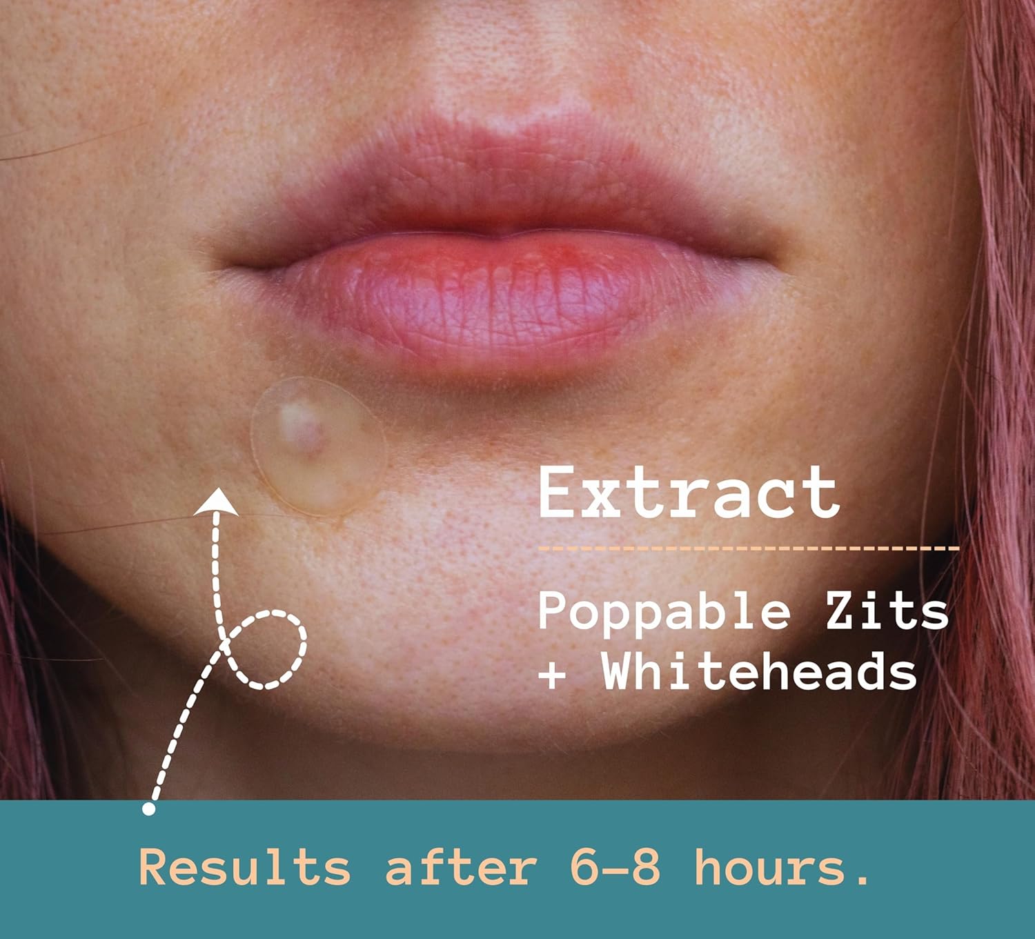 Anva Korean Acne Patches - Hydrocolloid Invisible Pimple Patches - Salicylic Acid Blemish Patches for Face - Zit Patches for Blemishes - Acne Dots Stickers for Pimples | 81 Count, 10mm & 12mm - Image 3