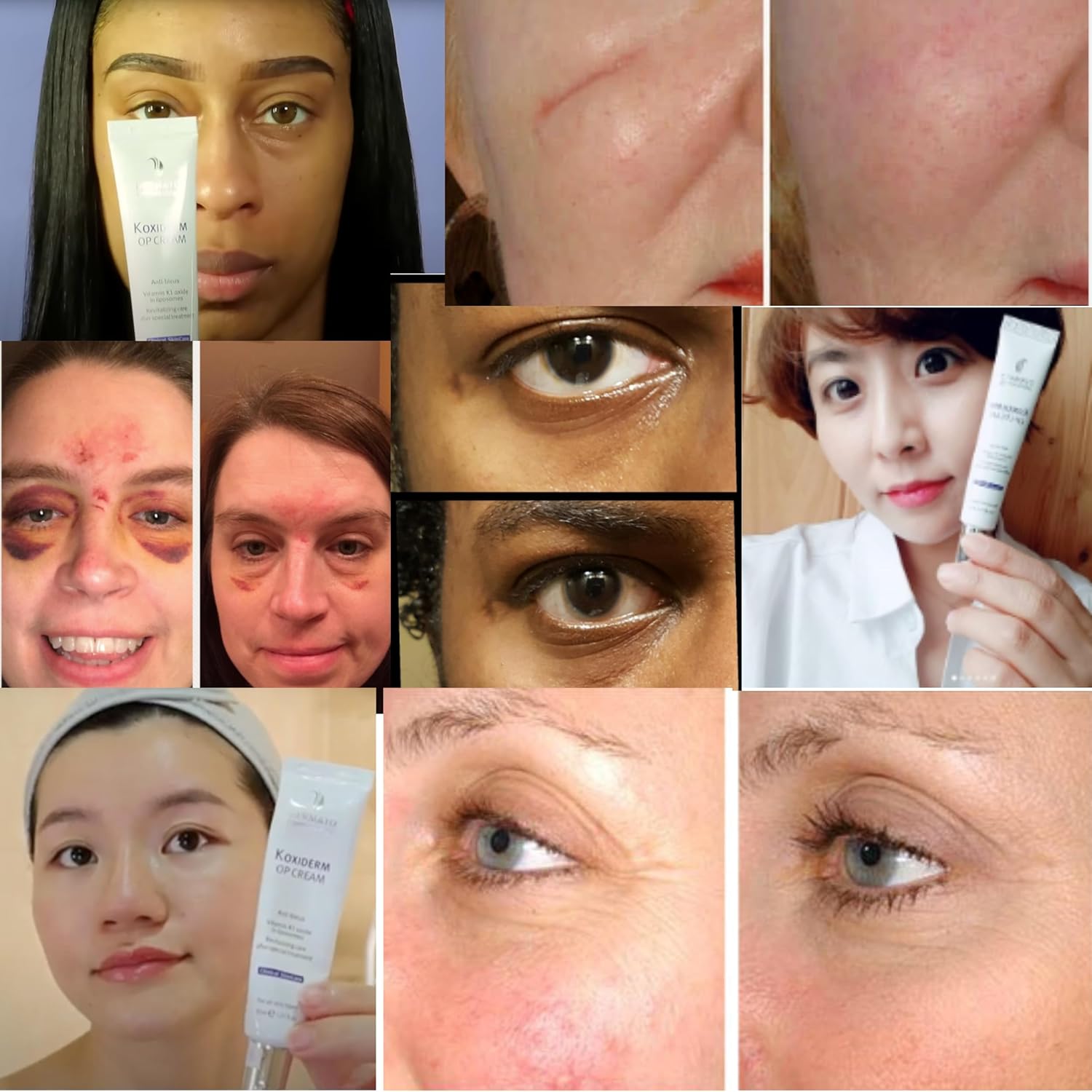 Vitamin K1 Oxiderm Cream Minimizing Appearance of Old and New Scars, Dark Eye Circles, Bruises, Varicose Veins, Purpura and Redness 1.01Oz - Image 4