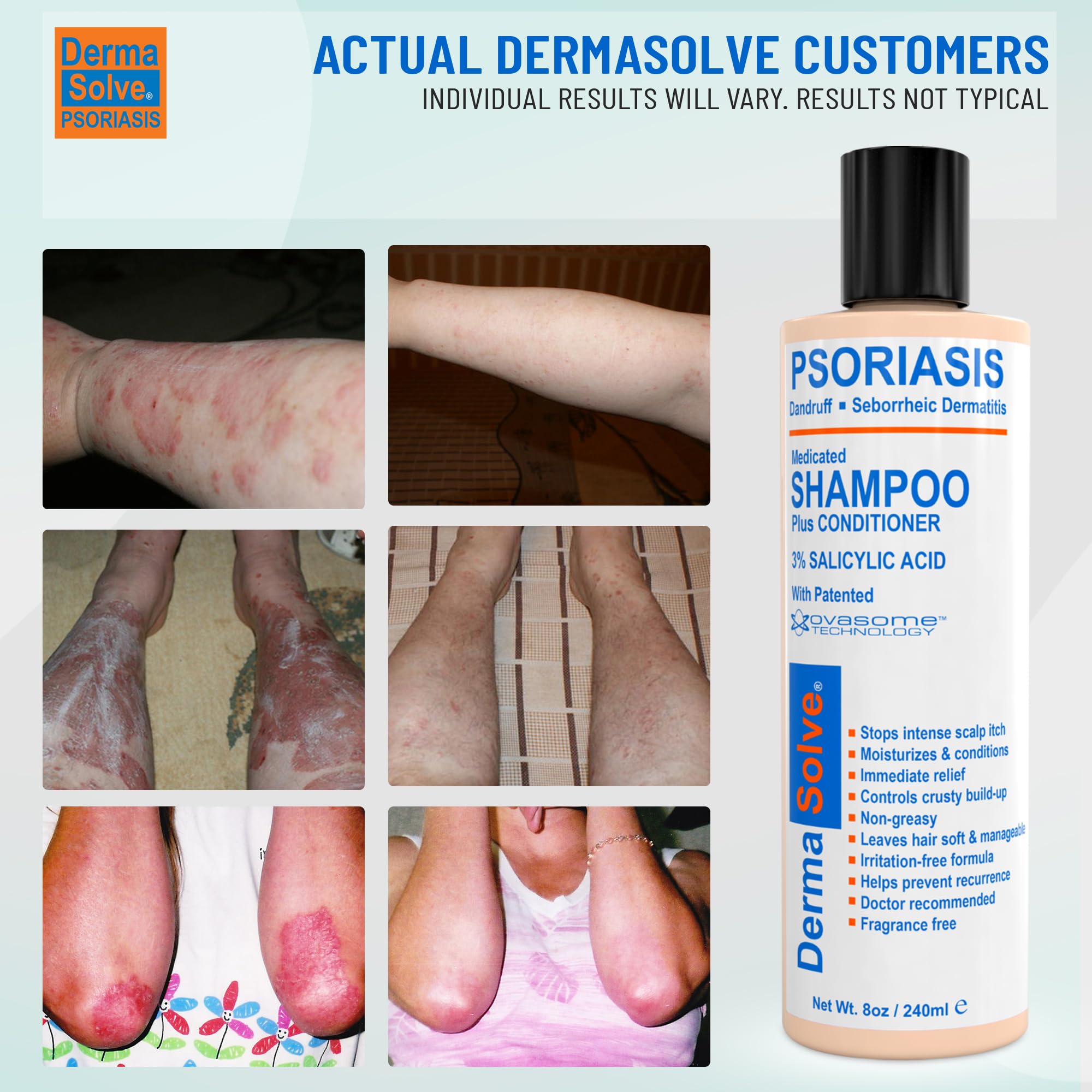 Dermasolve Champú medicinal sin caspa y psoriasis del cuero cabelludo con acondicionador, tratamiento definitivo para dermatitis sectorreal para picazón, cuero cabelludo escamoso, calmante