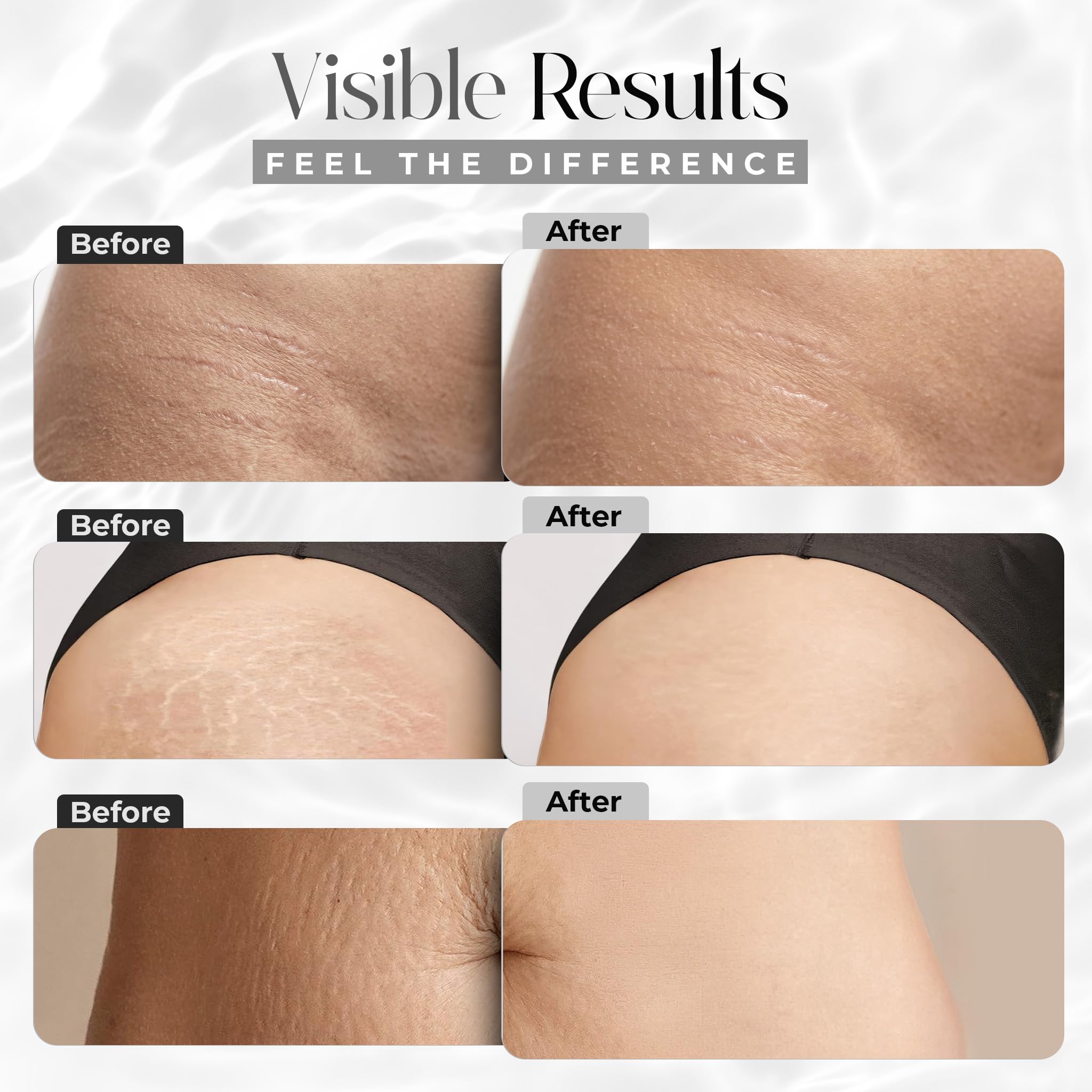 glutathione stretch marks Amazon.com : StretchMarkers Therapy Stretch Mark Cream – Visibly Reduces  and Treats, Stretch Marks Removal with Retinol, Hyaluronic Acid, Bioactive  Peptides & 3D Stem Cell Technology, 1 fl oz : Beauty & Personal Care