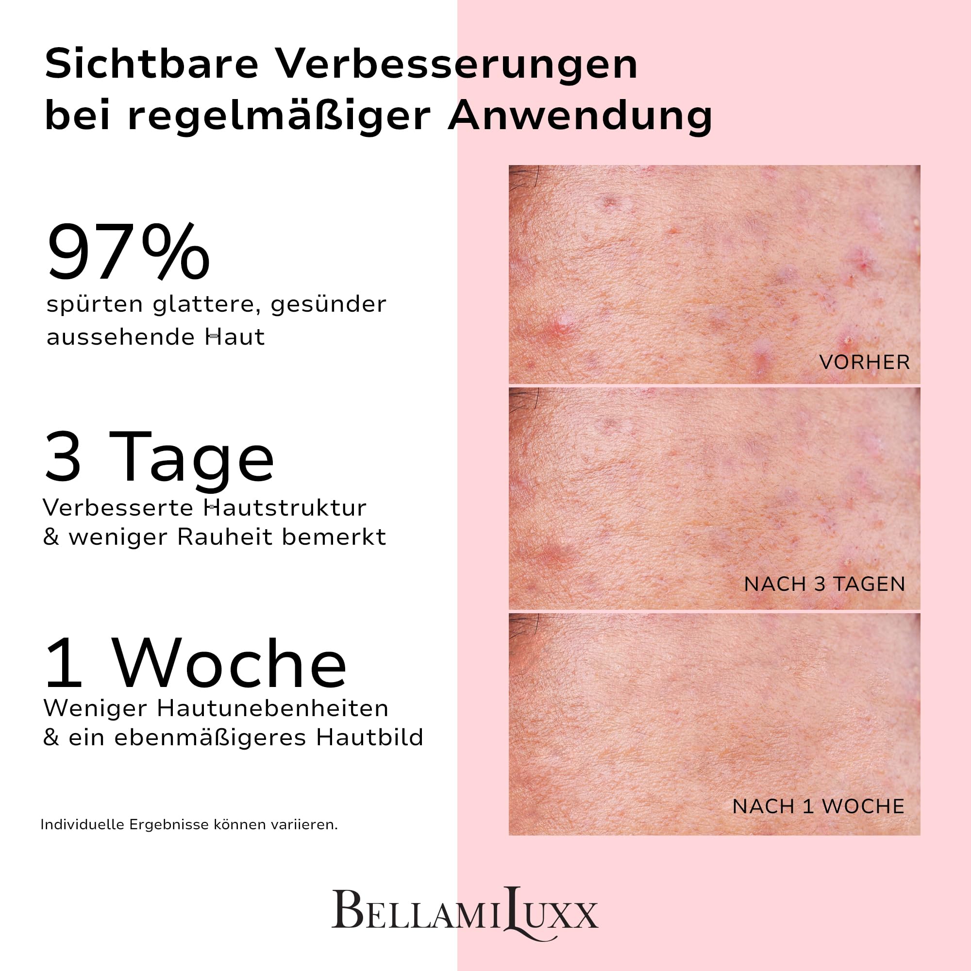 BellamiLuxx 3-teiliges Set gegen Pickel am Po – Lotion, Klärende Seife & Körperpeeling für Po, Oberschenkel & Rücken – Bei Hautunreinheiten, verstopften Poren & rauer Haut – Peelen, Reinigen & Glätten