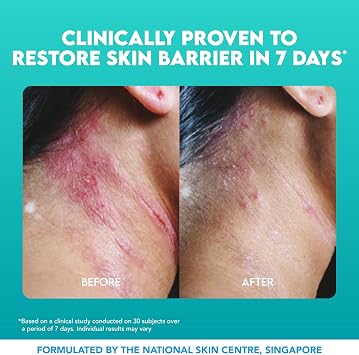 Suu Balm - Itch Relief Cream, Menthol & Ceramide Body Moisturiser - Itch Relief in 5 Minutes - Psoriasis, Dry, Sensitive Skin, Eczema Treatment (75ml))