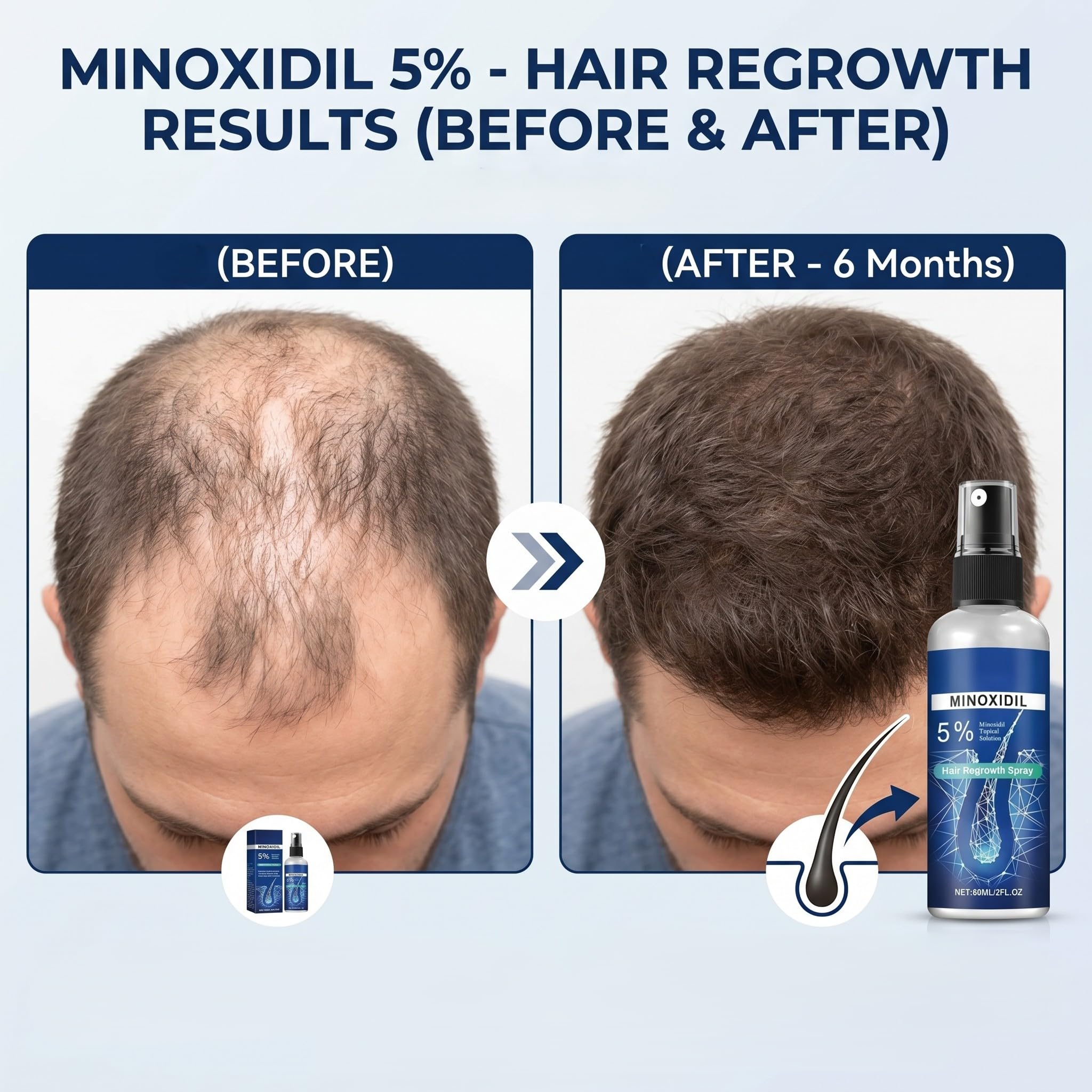 Minoxidil Hair Serum spray for Men and Women, 5% Minoxidil Hair Serum, promotes hair growth, makes hair and beard thicker and fuller- 60ml — view 3