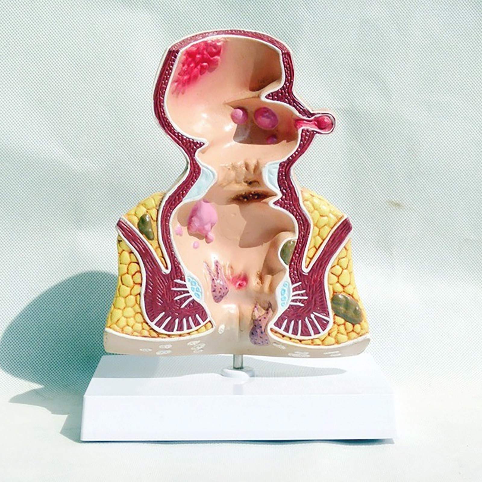 Modell Der Menschlichen Rektalen Pathologie, Modell Der Rektalen HäMorrhoidenpathologie, Modell Der Menschlichen Rektalen Anatomie, Medizinische Lehrmittel