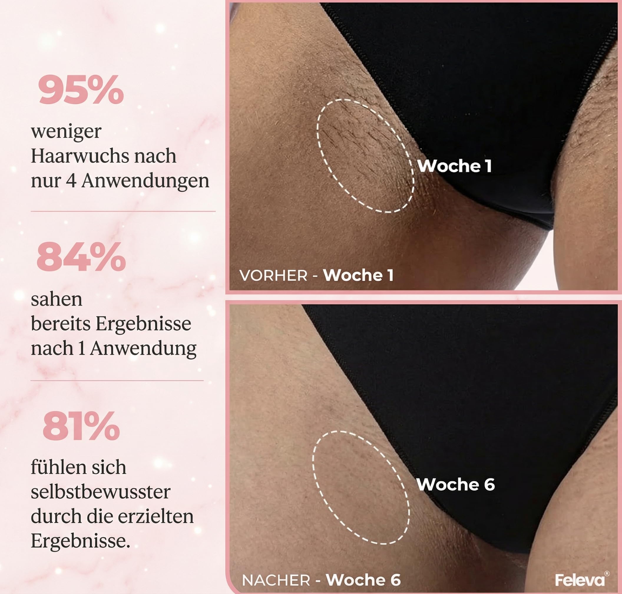 Loop Von Solippy-Effektives IPL Gerät zur dauerhaften Haarentfernung für Frauen und Männer – Ideal für Beine, Arme und Gesicht (Weiß 470nm-1100nm)