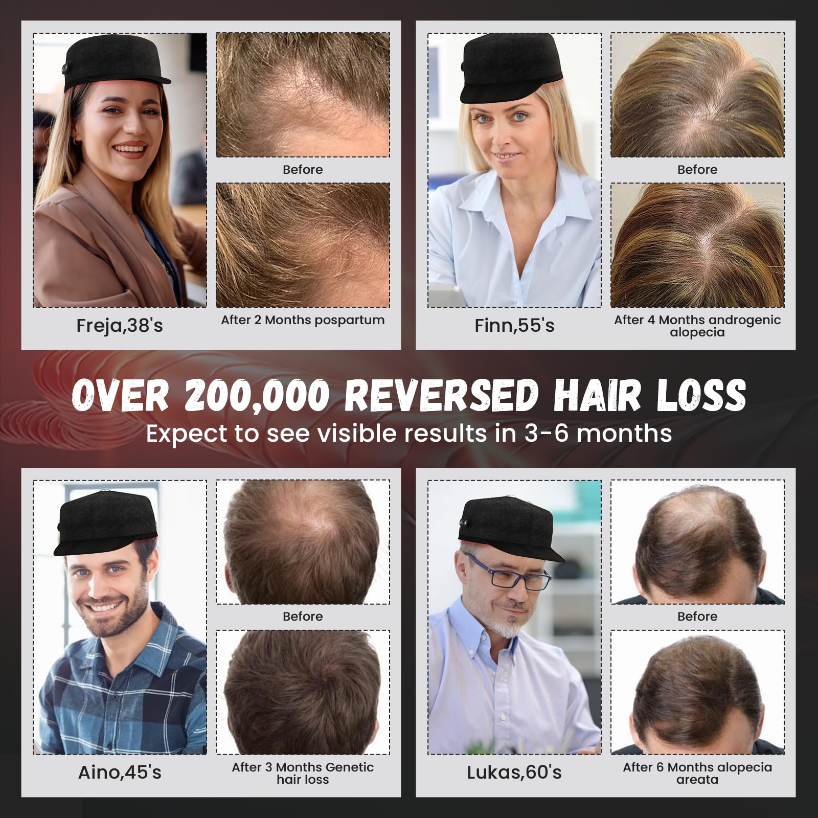 iKeener Gorro para el Crecimiento del Cabello con Luz Roja, Doble Onda 108 LEDs Inalámbrico Recargable Casco Terapia con Luz Roja para el Cuidado del Cabello de Mujeres y Hombres