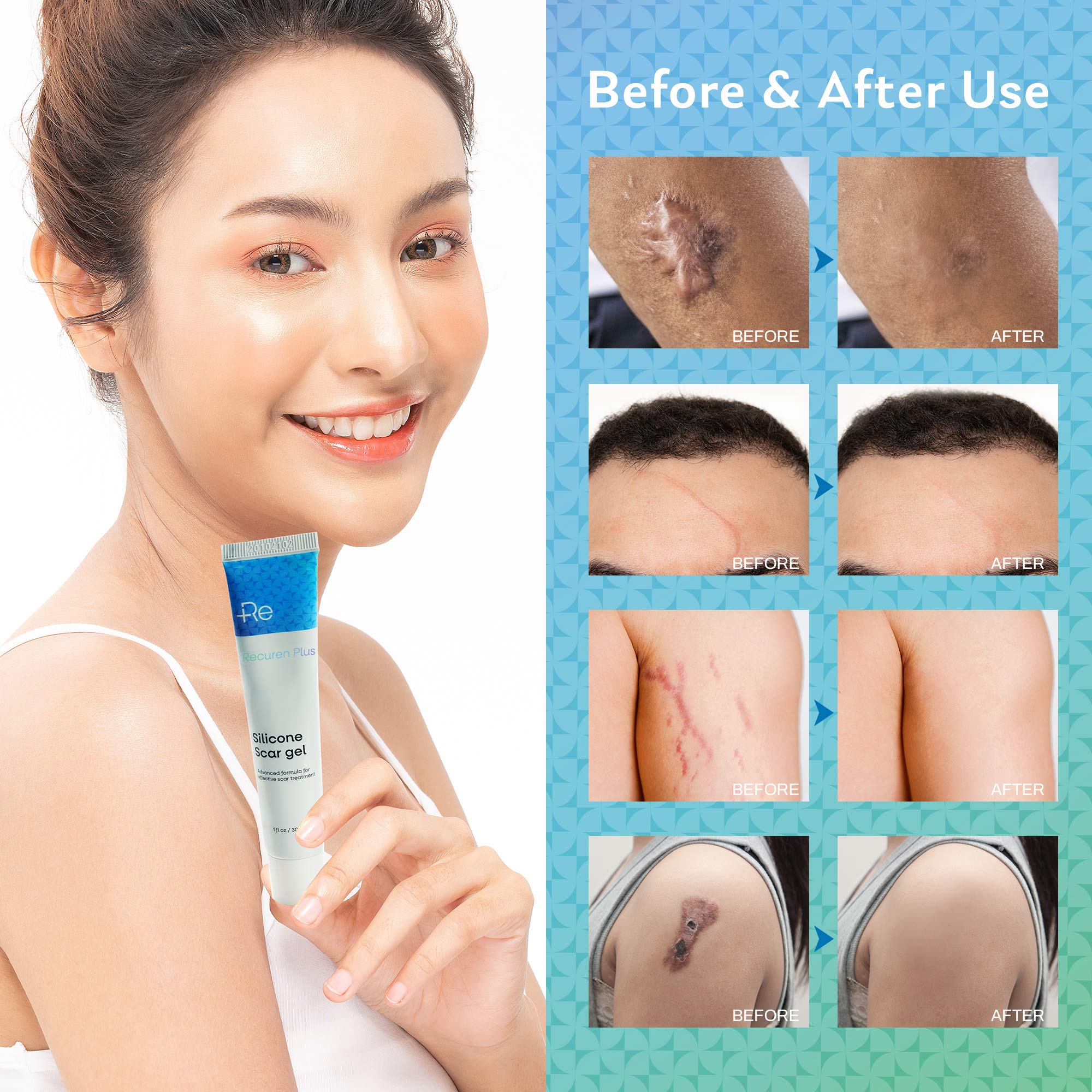 Buy Recuren Plus Silicone Scar gel, Advanced Scar Solution, for C