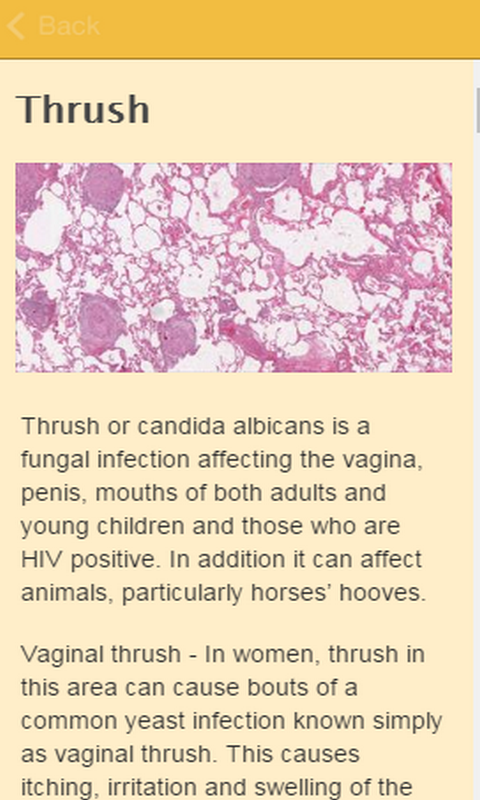 Thrush In Woman