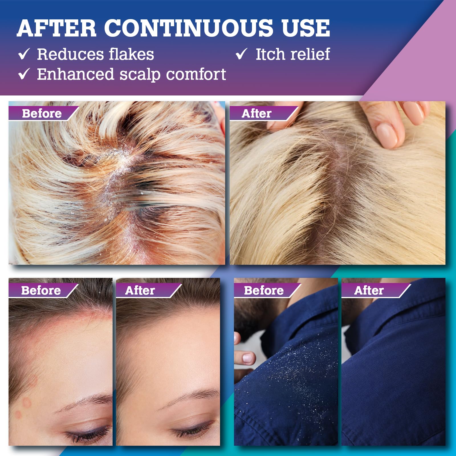 Shampoo Scalp per dermatite seborroica e psoriasi