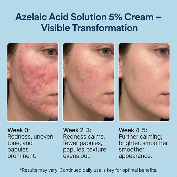 Maruderm Azelaik Asit%5 Cilt Bakım Kremi – Kızarıklık, Lekelenme ve Cilt Tonu Düzensizliğine Karşı, Meyan Kökü & Hyaluronik Asit ile, 200 ML