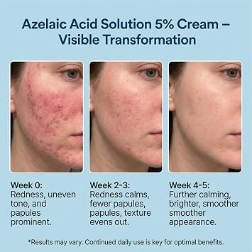 Maruderm Azelaik Asit%5 Cilt Bakım Kremi – Kızarıklık, Lekelenme ve Cilt Tonu Düzensizliğine Karşı, Meyan Kökü & Hyaluronik Asit ile, 200 ML