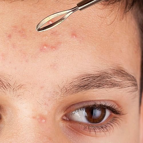 Miniatura 8 de 2 Herramienta profesional de acero inoxidable para eliminar puntos negros, herramienta extractor de manchas  acné, piel, nariz, cara, zona de