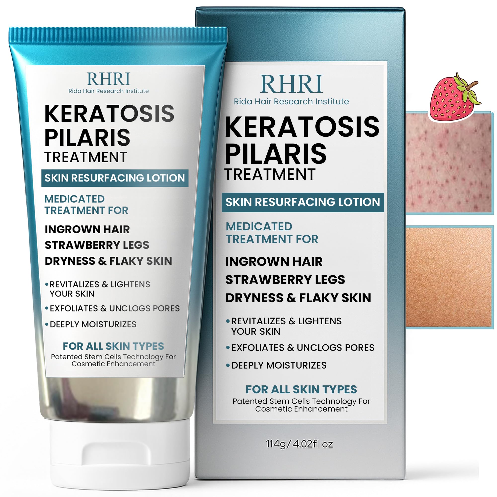 Keratosis Pilaris Treatment | Keratosis Pilaris Lotion | KP Lotion | Gentle Exfoliation For Strawberry Legs, KP & Ingrown Hairs | Smooth & Hydrating Body Lotion For Redness, Dry, Rough And Flaky Skin