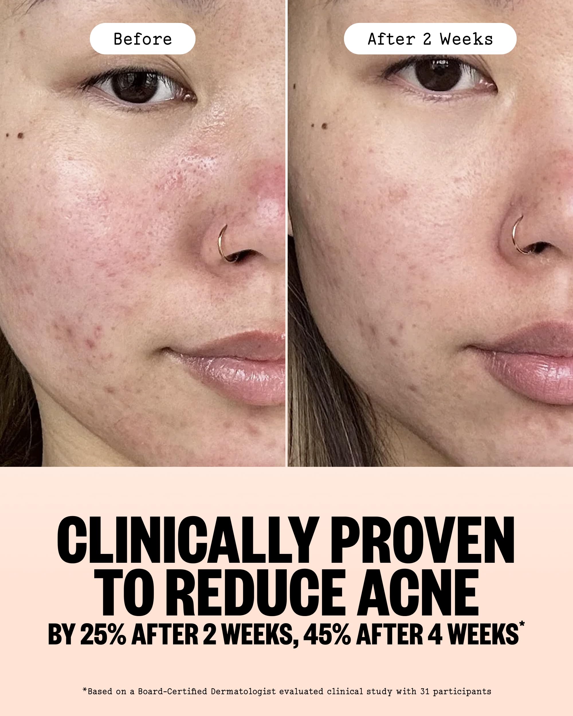 PEACE OUT Acne Gel Cleanser with 2% Salicylic Acid, 4 fl oz