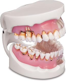 Practicon 4112128 Pathological Gingivitis Model