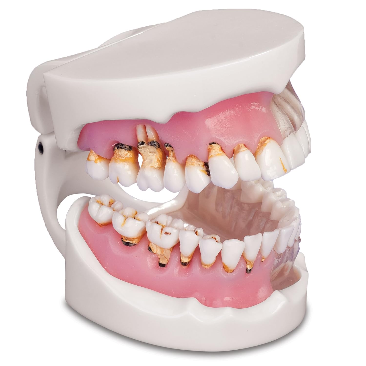 Practicon 4112128 Pathological Gingivitis Model