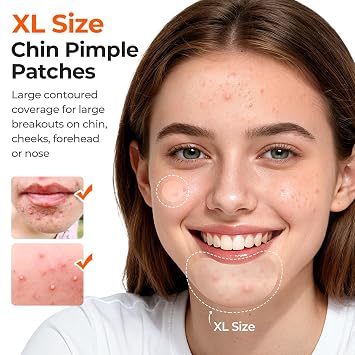 TKTK Pimple Patches Pimple Patches for Face Hydrocolloid Acne Patches Zit Patches for Chin and Nose Skin Care 5 Sizes 136 Count