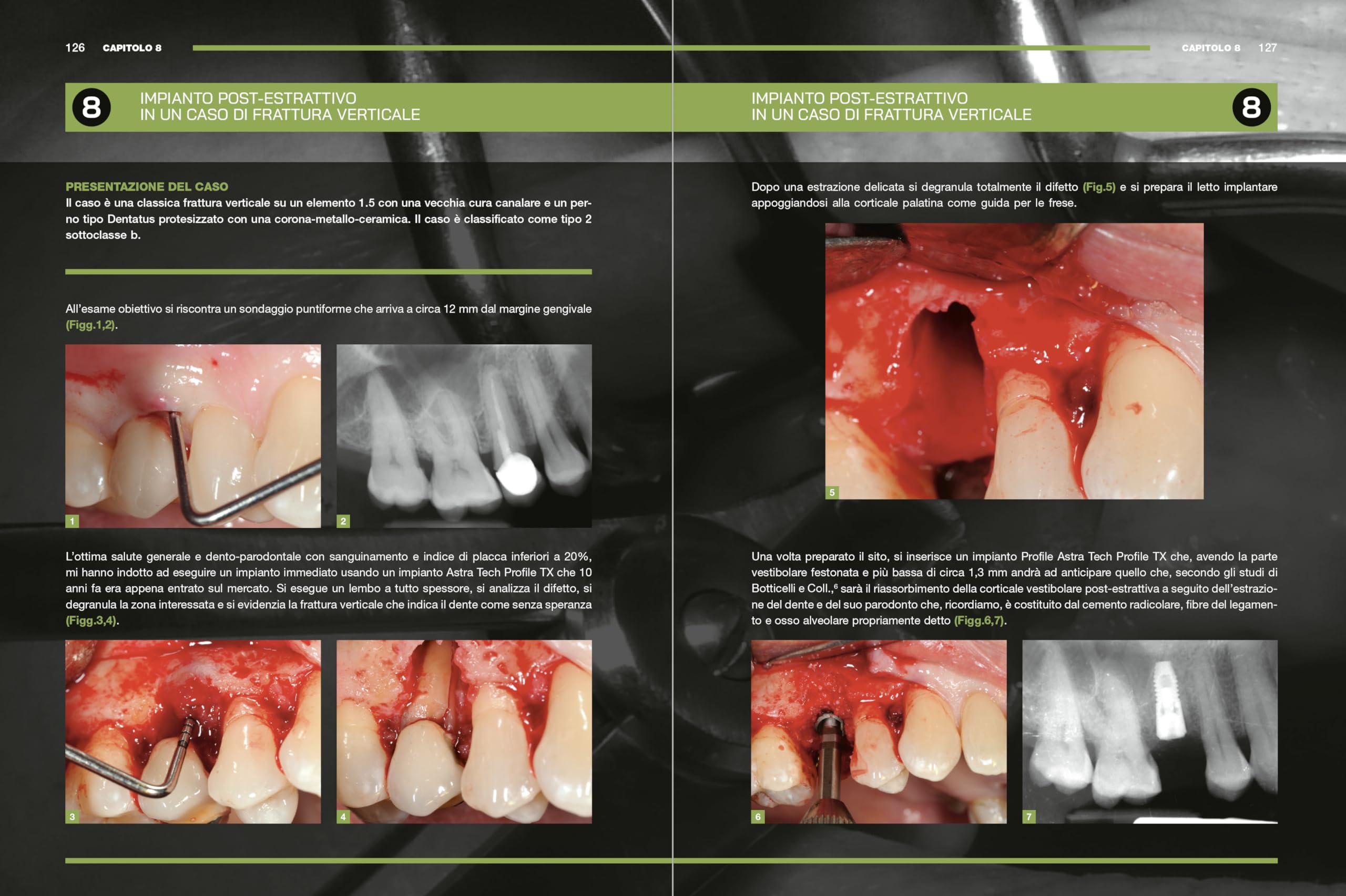 Impianti immediati. Manuale clinico operativo con procedure step by step
