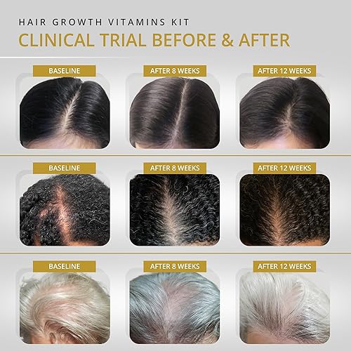 Miniatura 3 de VITAMINS REVIVE Vitaminas para el crecimiento del cabello Suplemento vegano para mujeres, clínicamente probado en Estados Unidos, adelgazamiento y