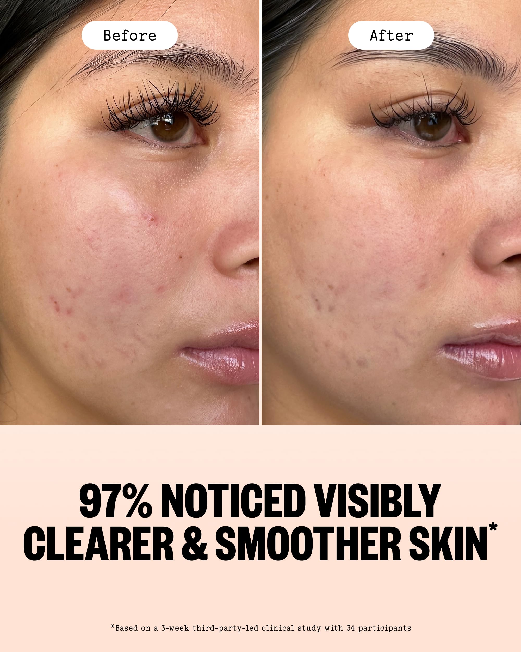 PEACE OUT Acne Gel Face Moisturizer with Salicylic Acid & Ceramides