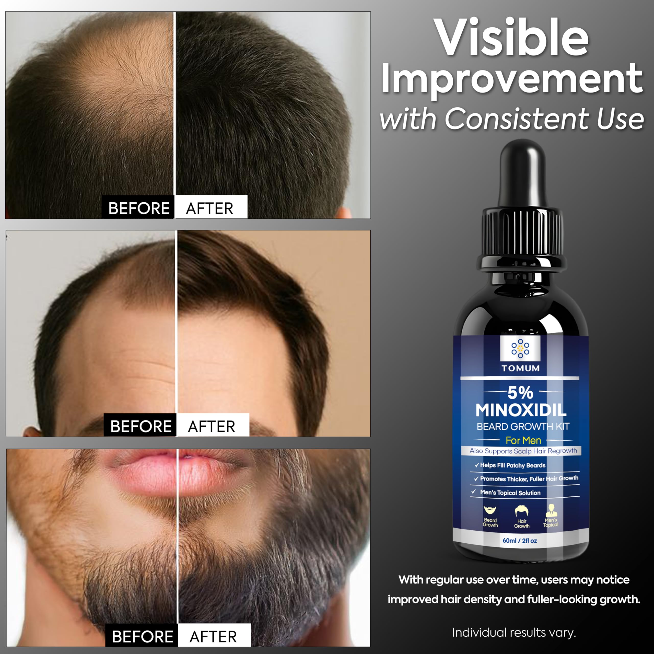 l-carnitina en el rostro  La Adipoestructudacin consiste en tratar cada panculo adiposo del rostro  con principios activos especficos, generalmente uso Cafena , Carnitina y  otros para quemar grasas acumuladas, por ejemplo bolsas de los ojos,