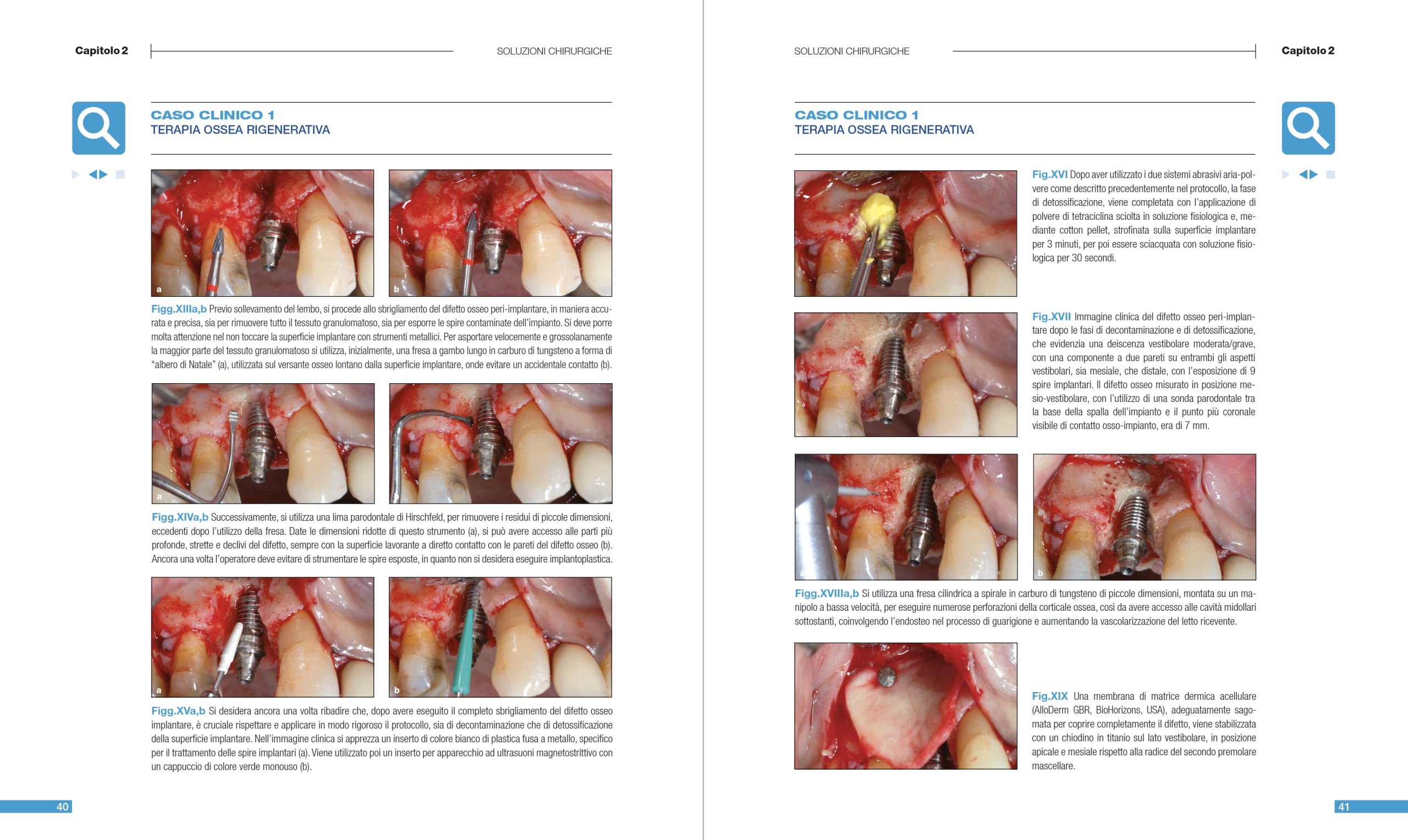 Malattie peri-implantari. Trattamenti chirurgici