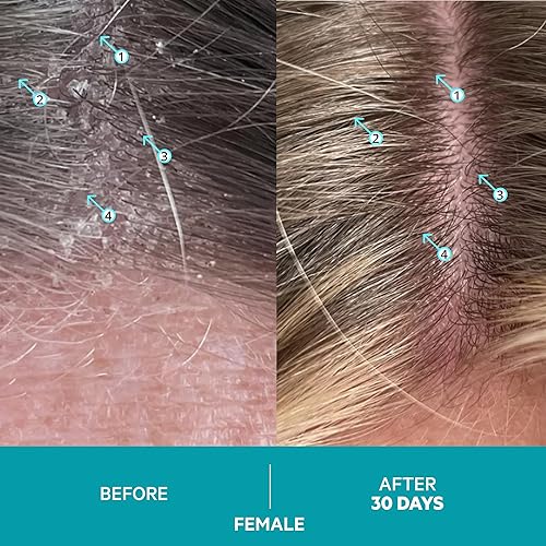 Miniatura 4 de DS Laboratories - Champú para caspa de caspa para picazón cuero cabelludo seco champú para psoriasis champú para dermatitis seborreica para hombres