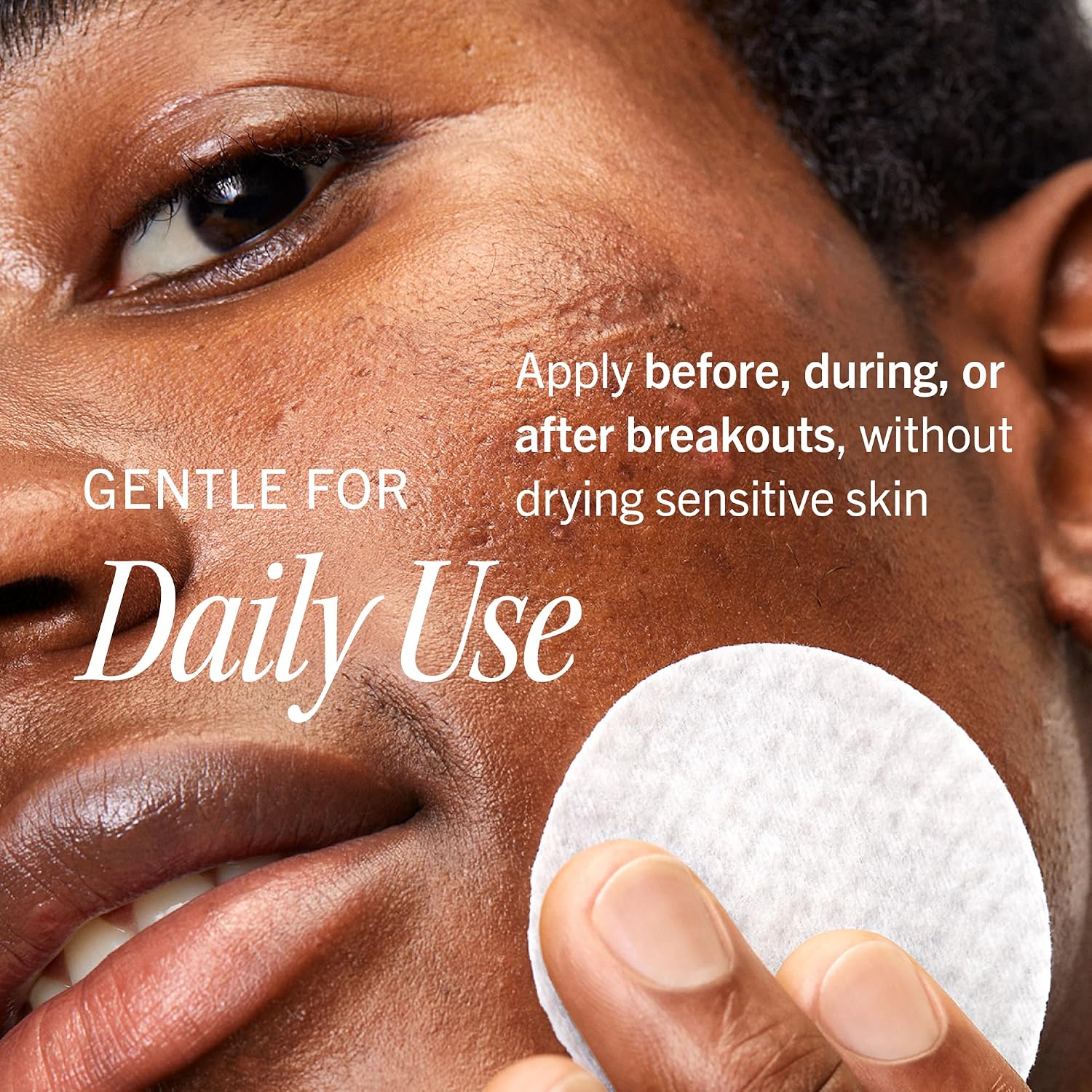 First Aid Beauty Acne Treatment Pads, 2% Salicylic Acid Maximum Strength Acne Pads for Face, Non-Drying Formula, Sensitive Skin, 28 ct