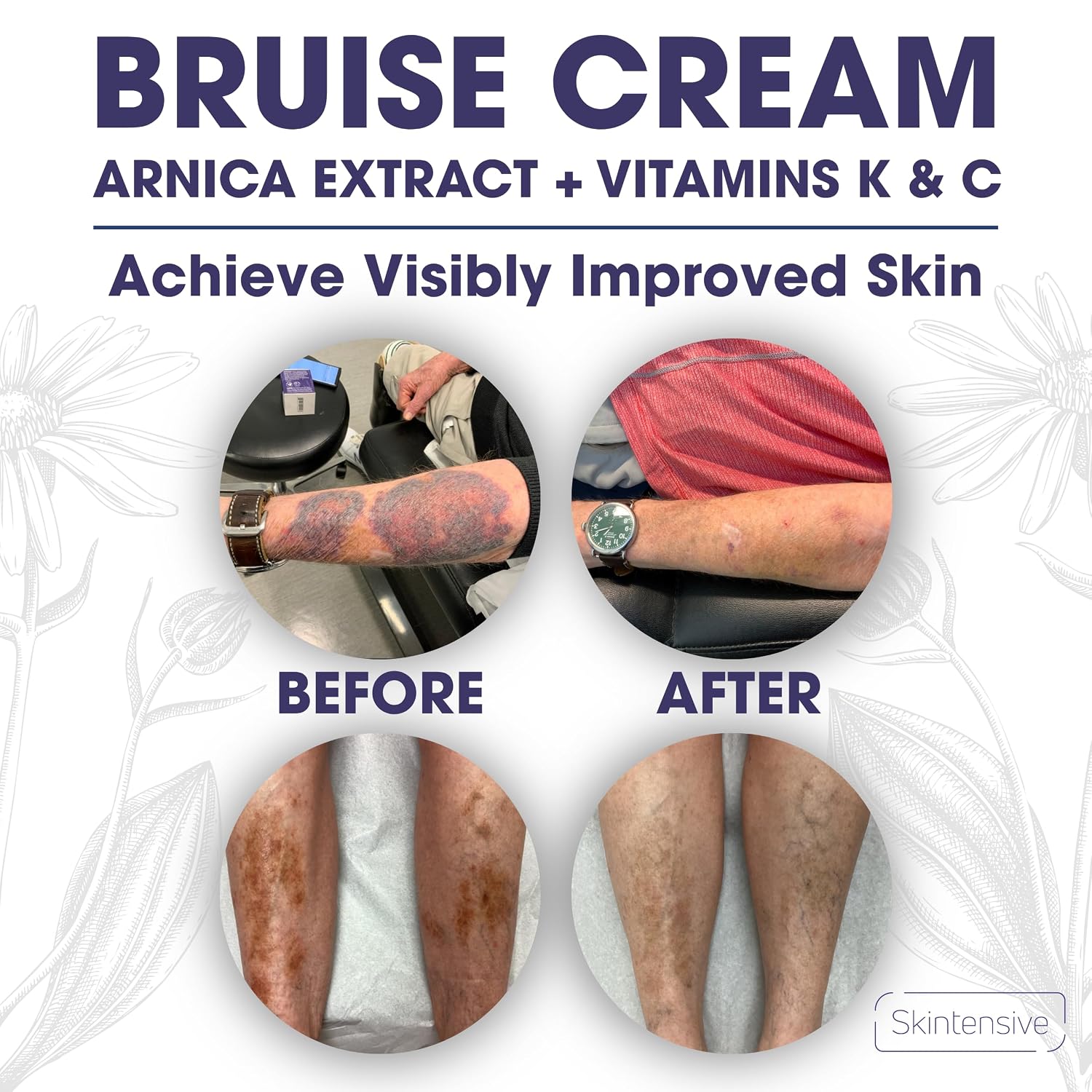 SKINTENSIVE Arnica Bruise Cream for Thin Skin – Vitamin K Cream for Bruises & Skin Discoloration, Moisturizing Arnica Cream for Seniors, Non-Greasy Formula, 4 Oz (2 Pack)